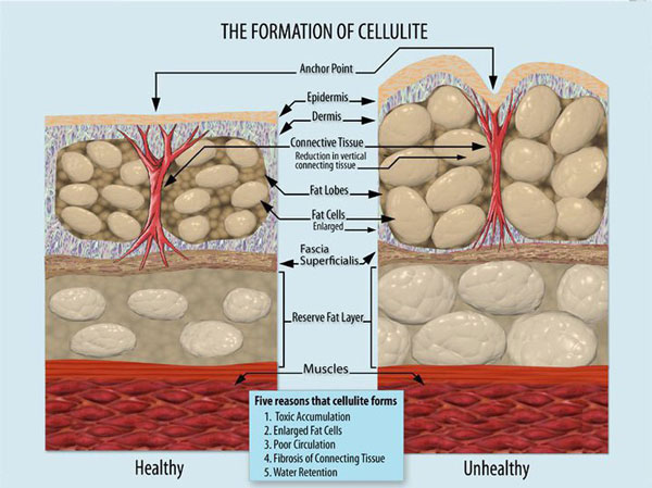 the formation of cellulite