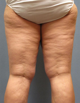 what is cellulite in aged women